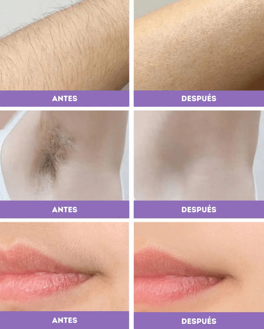 Depiladora láser: Dile adiós a los vellitos indeseados