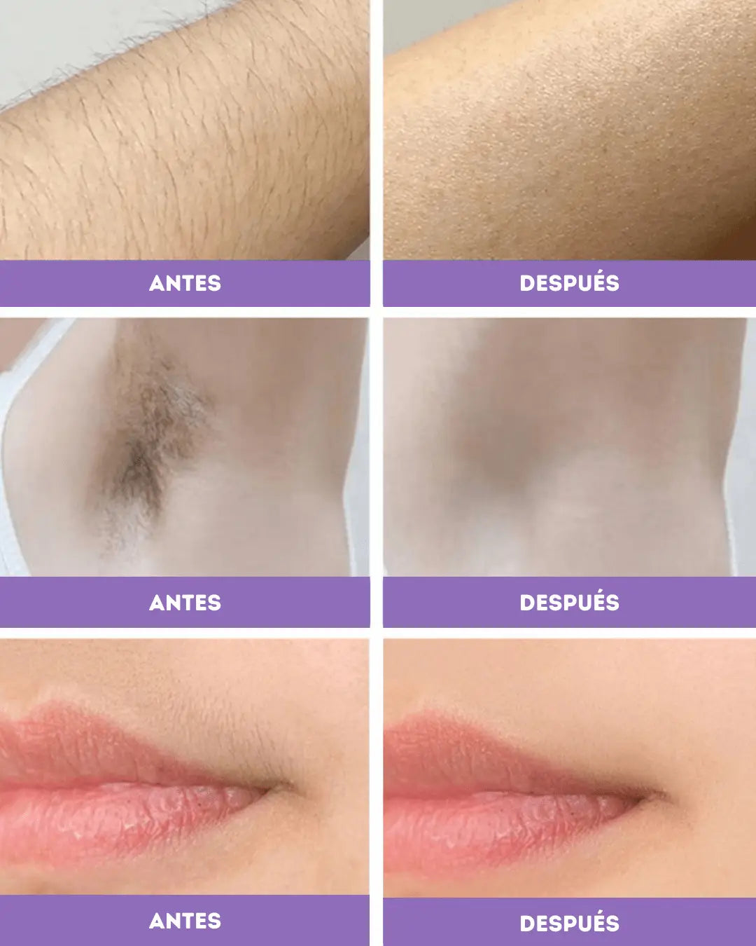 Depiladora láser: Dile adiós a los vellitos indeseados